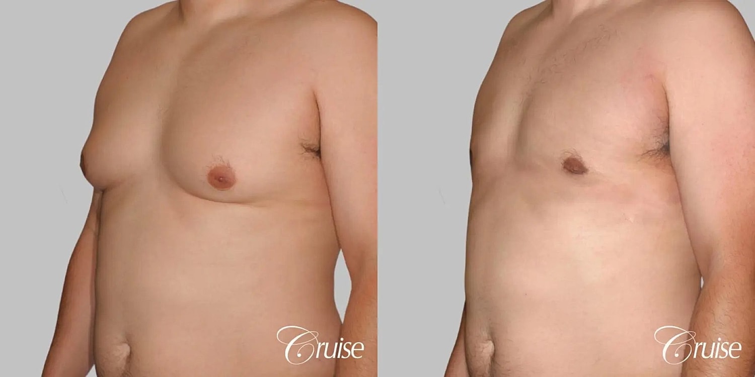 Gynecomastia Surgery Before & After