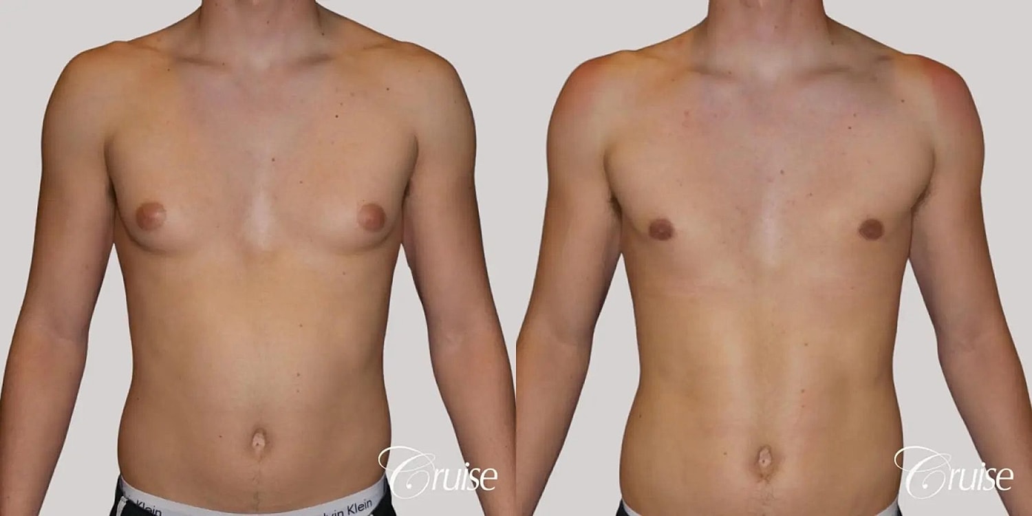 Gynecomastia Surgery Before & After
