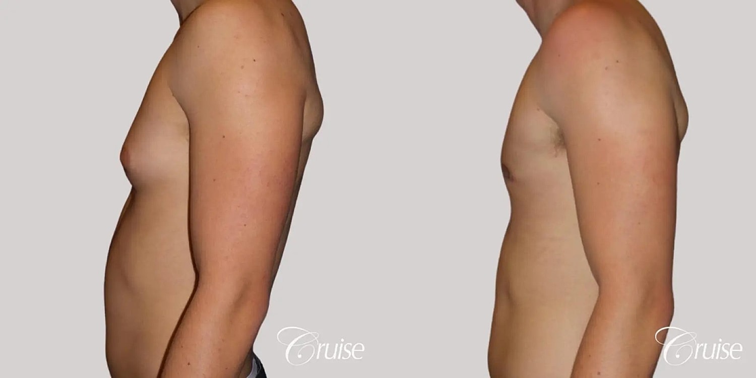 Gynecomastia Surgery Before & After