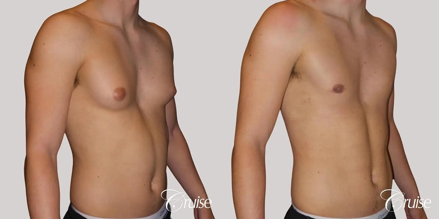 Gynecomastia Surgery Before & After