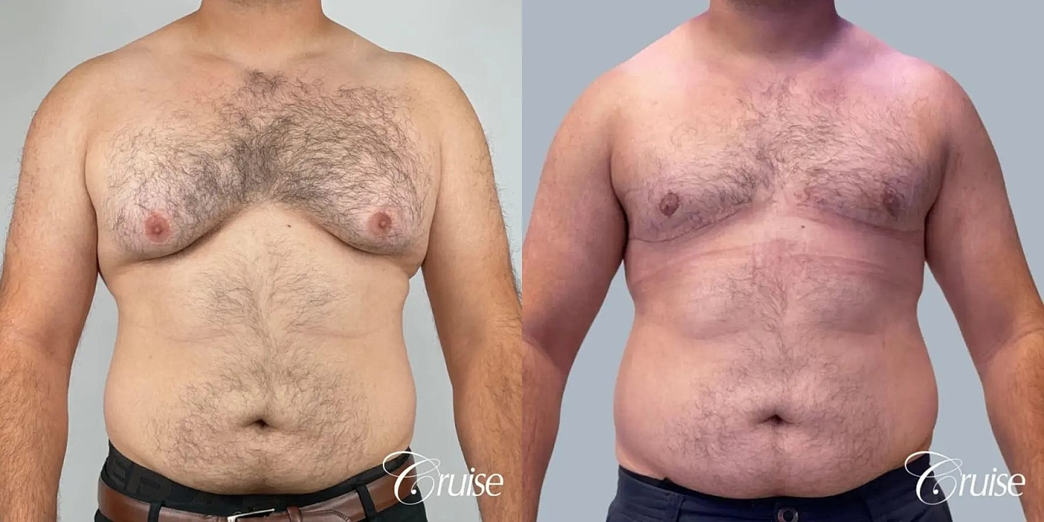 Gynecomastia Surgery Before & After