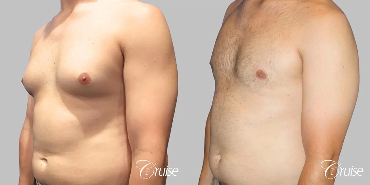 Gynecomastia Surgery Before & After