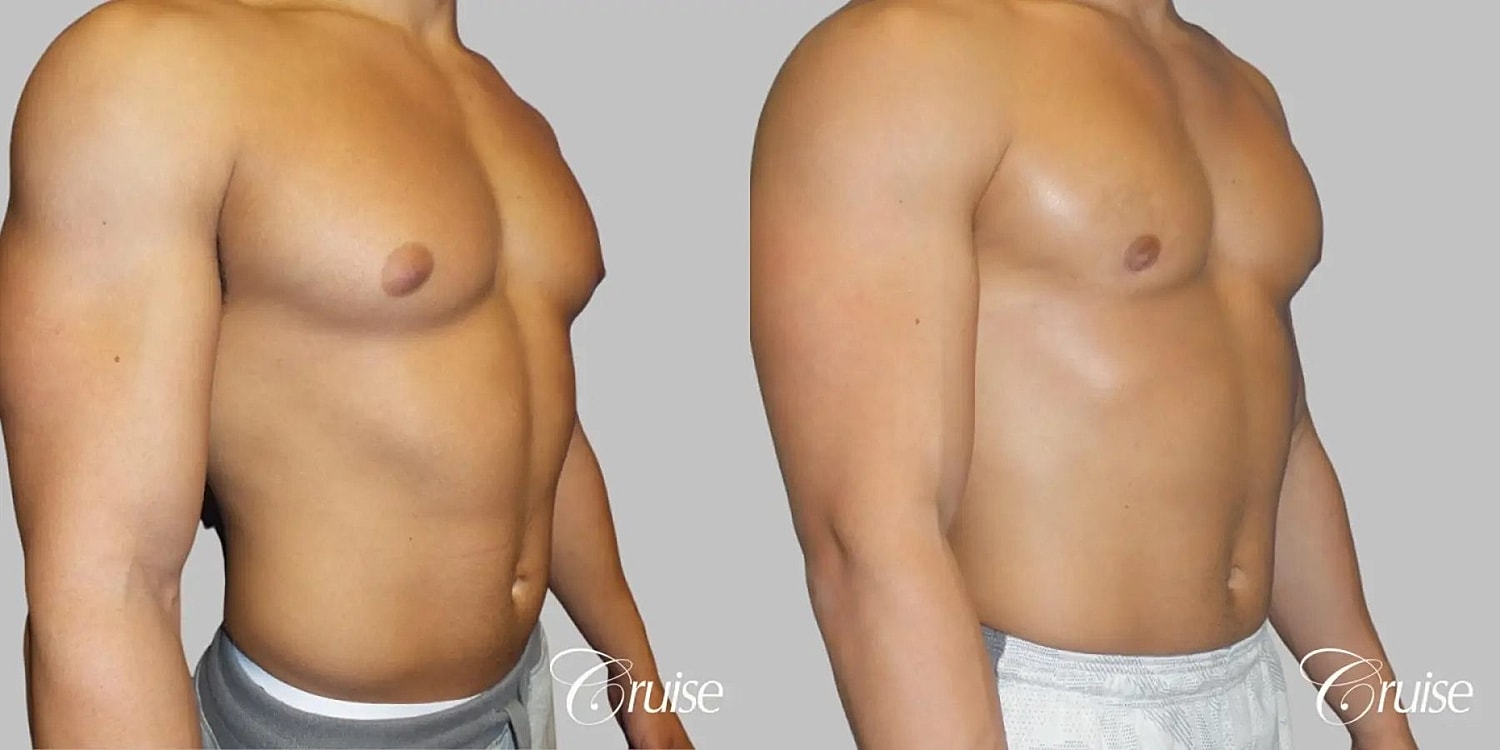 Gynecomastia Surgery Before & After