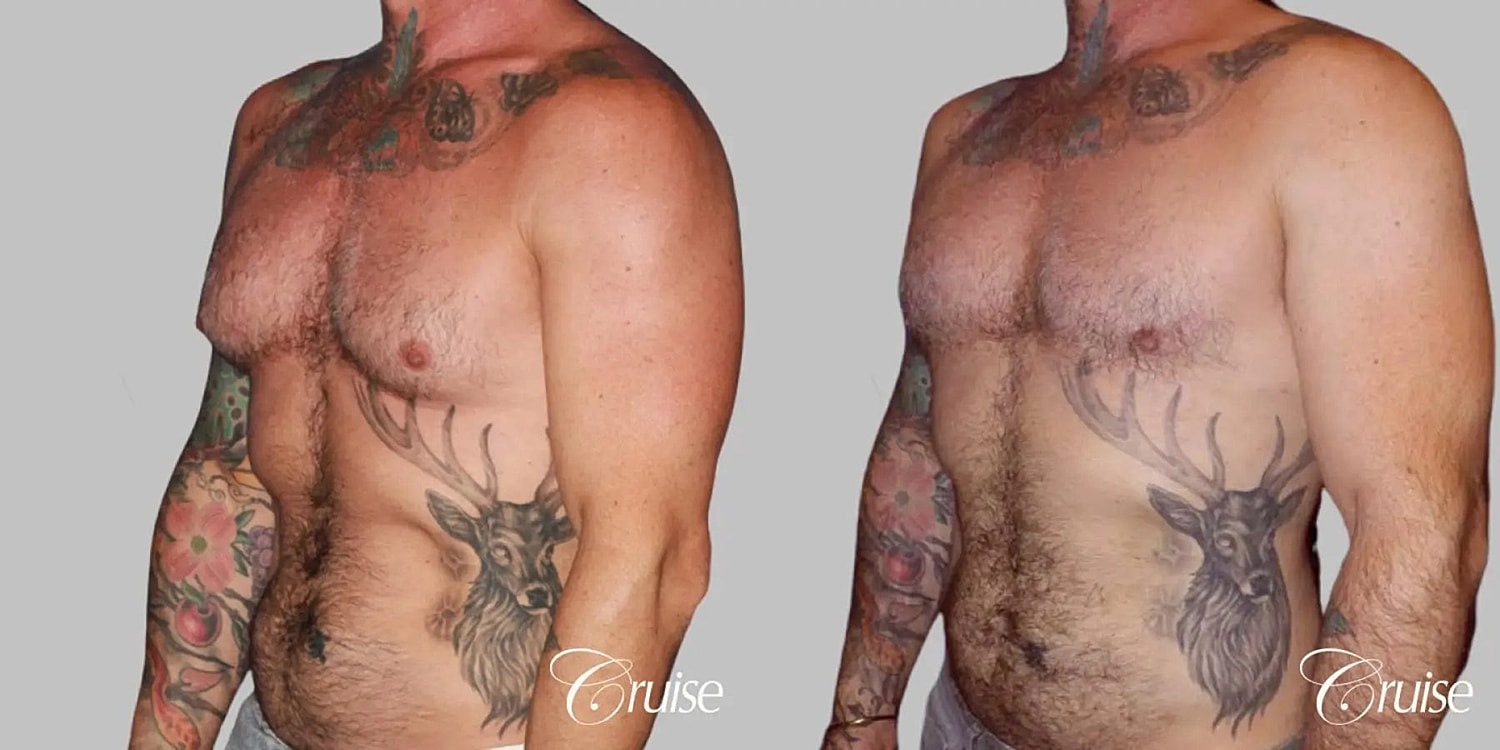 Gynecomastia Surgery Before & After