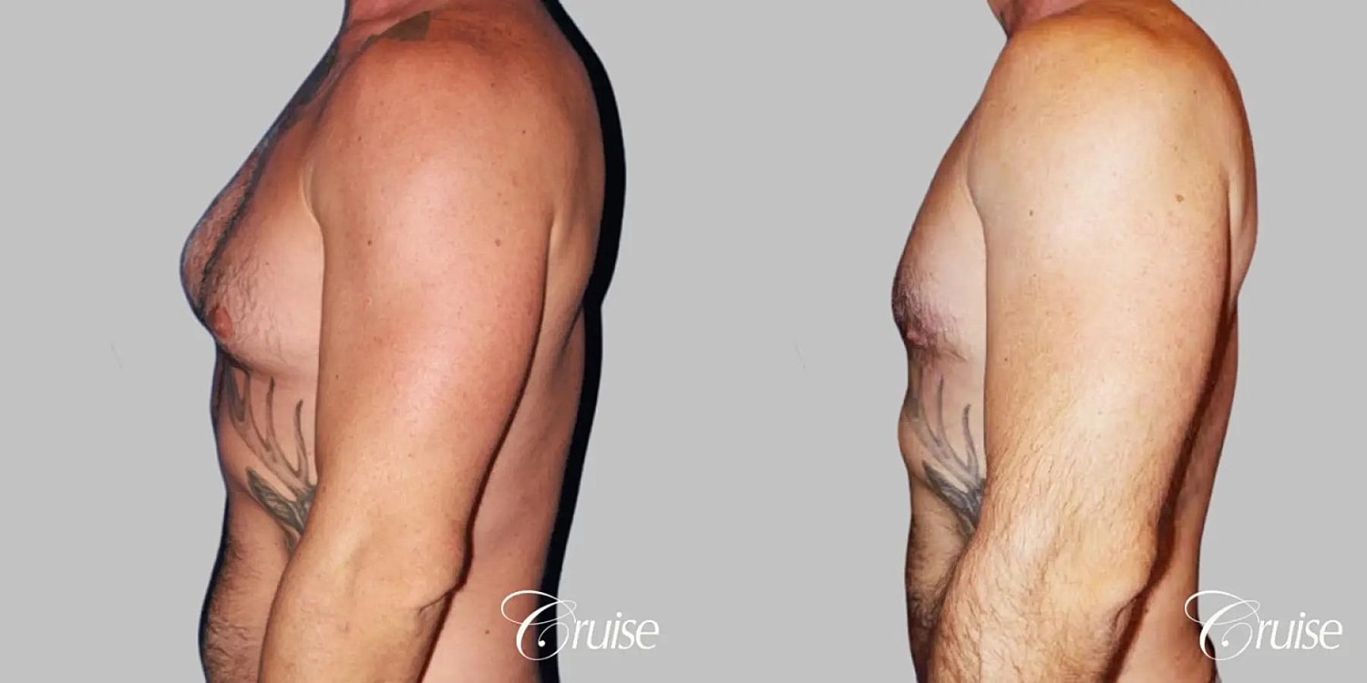 Gynecomastia Surgery Before & After