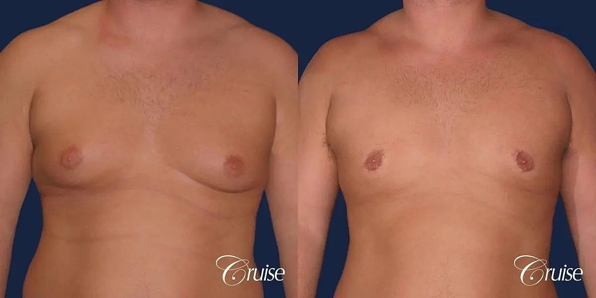 Gynecomastia Surgery Before & After