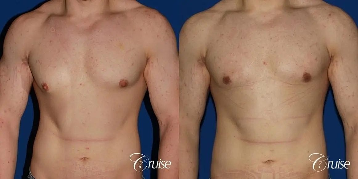 Gynecomastia Surgery Before & After
