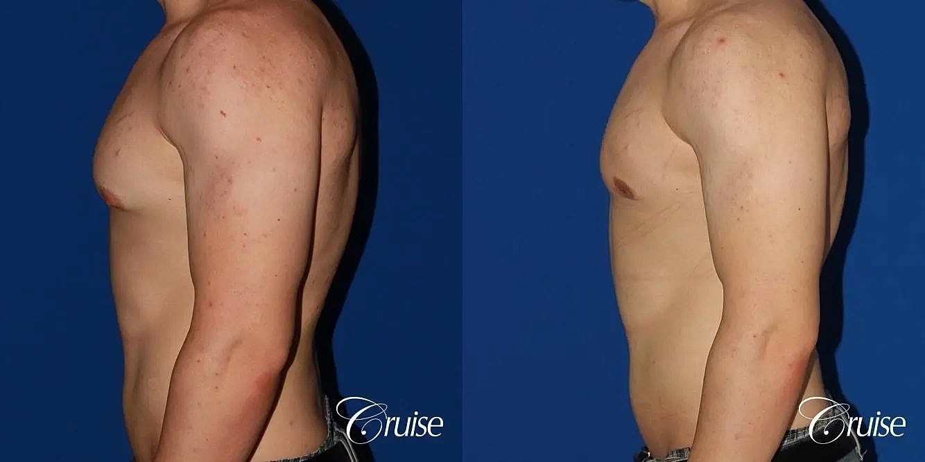 Gynecomastia Surgery Before & After