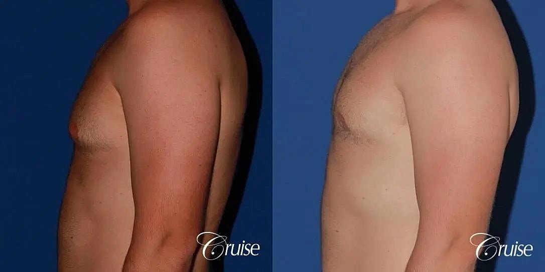 Gynecomastia Surgery Before & After