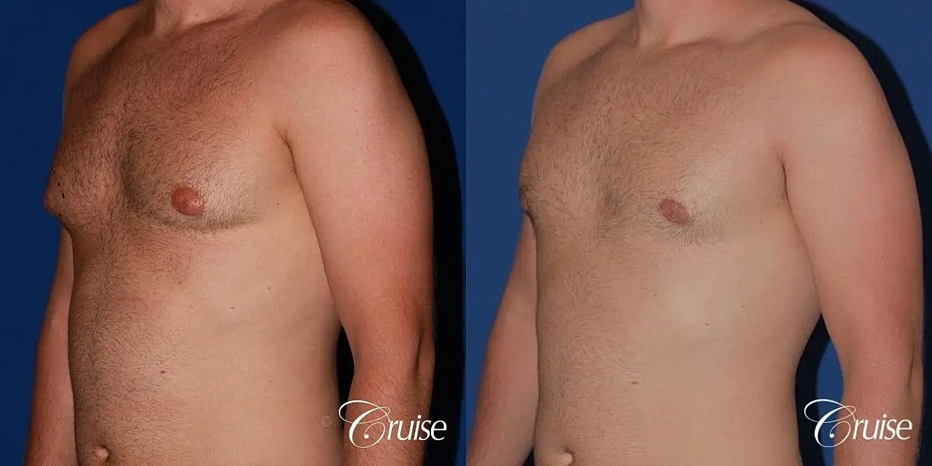 Gynecomastia Surgery Before & After