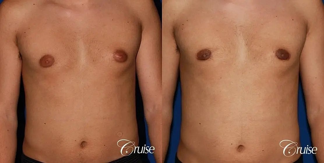 Gynecomastia Surgery Before & After
