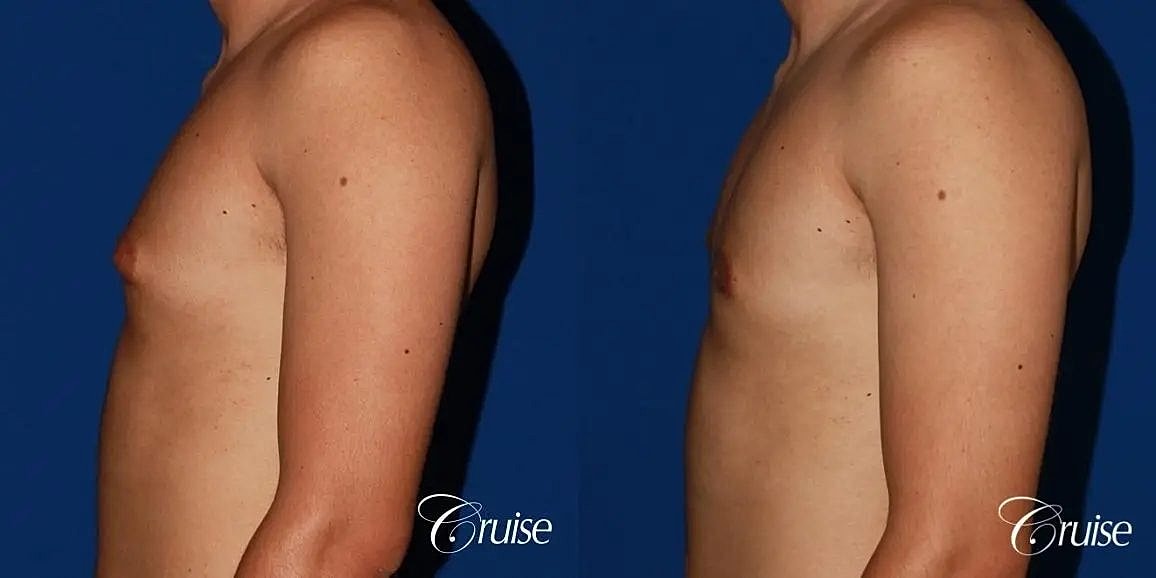 Gynecomastia Surgery Before & After