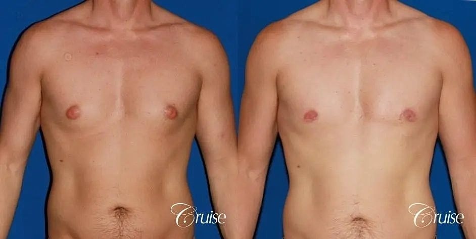 Gynecomastia Surgery Before & After