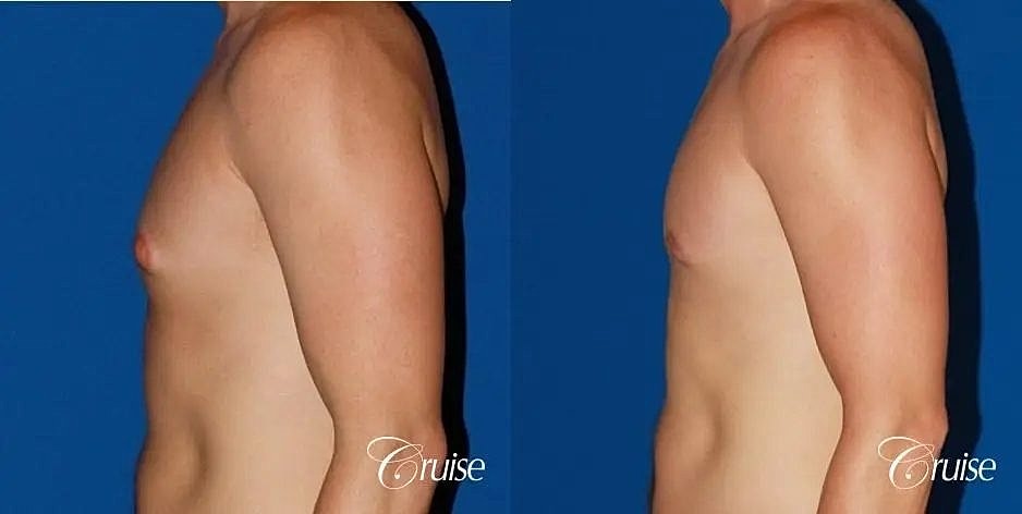 Gynecomastia Surgery Before & After