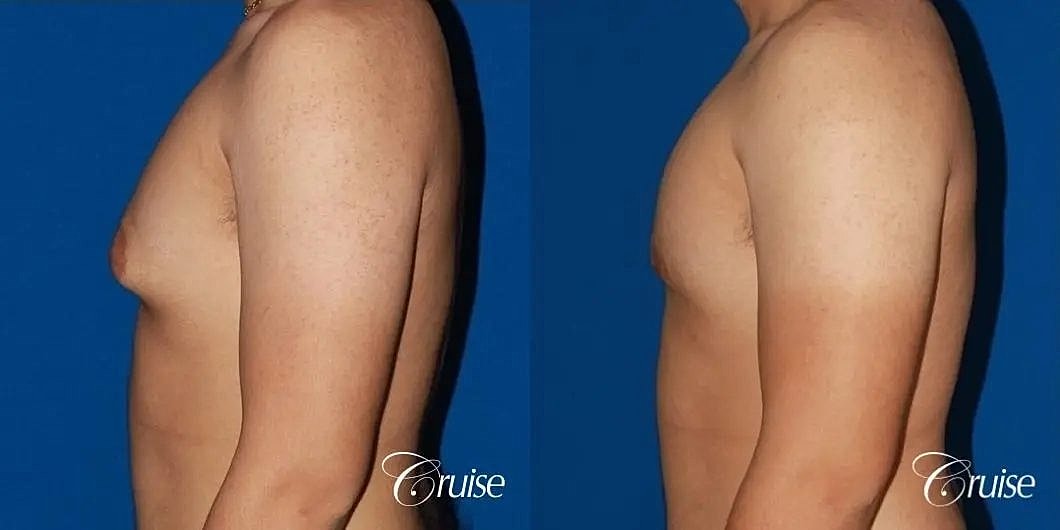 Gynecomastia Surgery Before & After