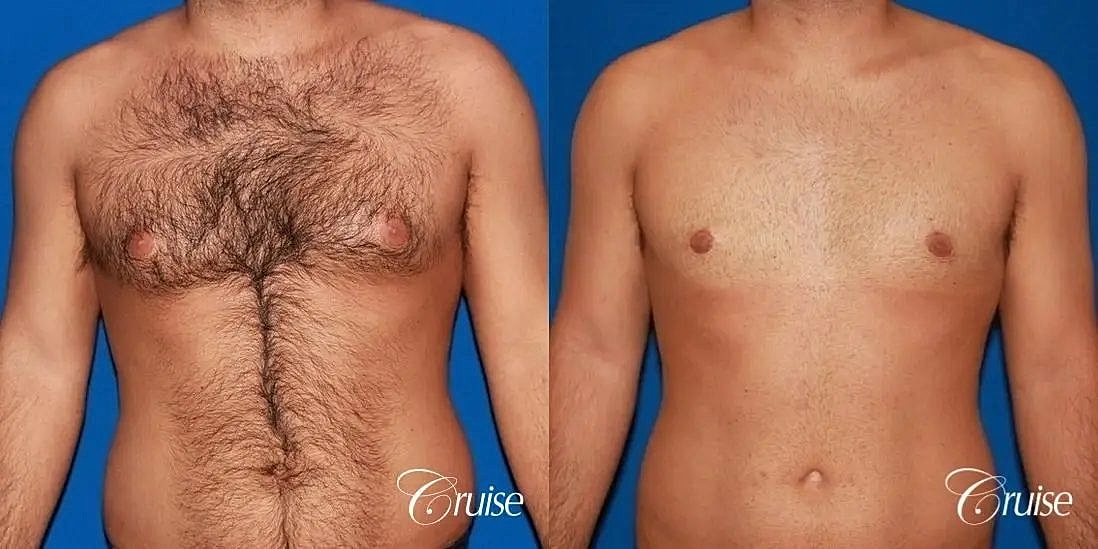 Gynecomastia Surgery Before & After