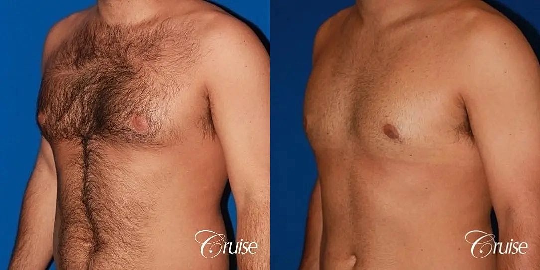 Gynecomastia Surgery Before & After