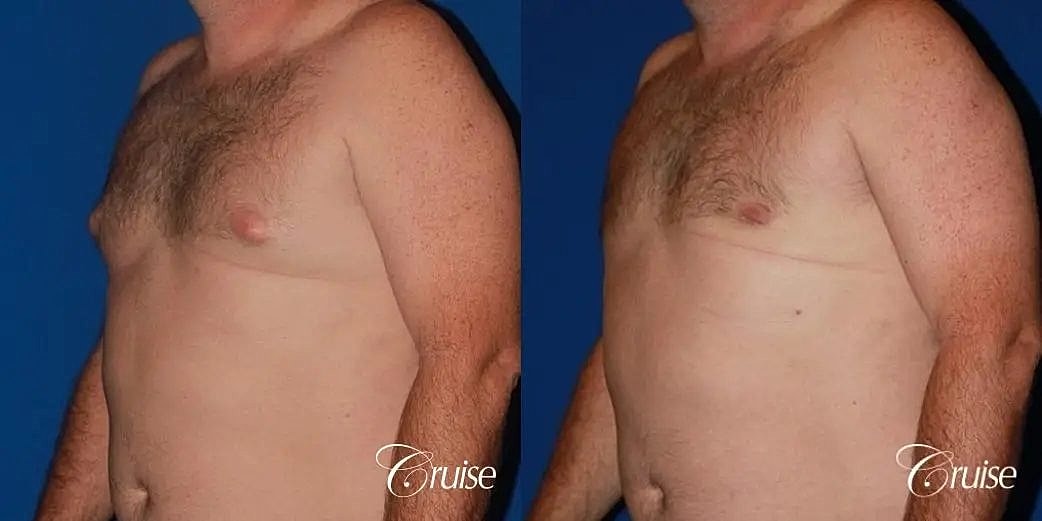 Gynecomastia Surgery Before & After