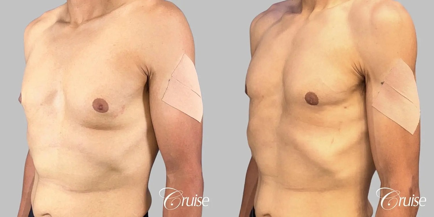 Gynecomastia Surgery Before & After