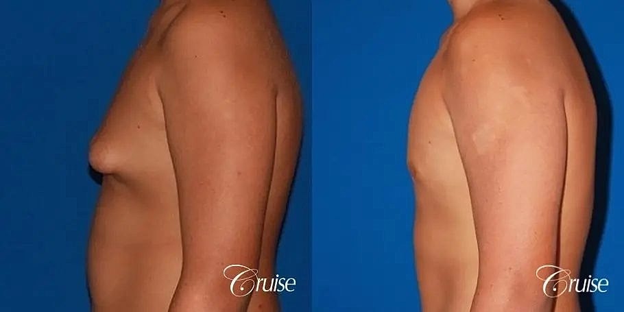 Gynecomastia Surgery Before & After