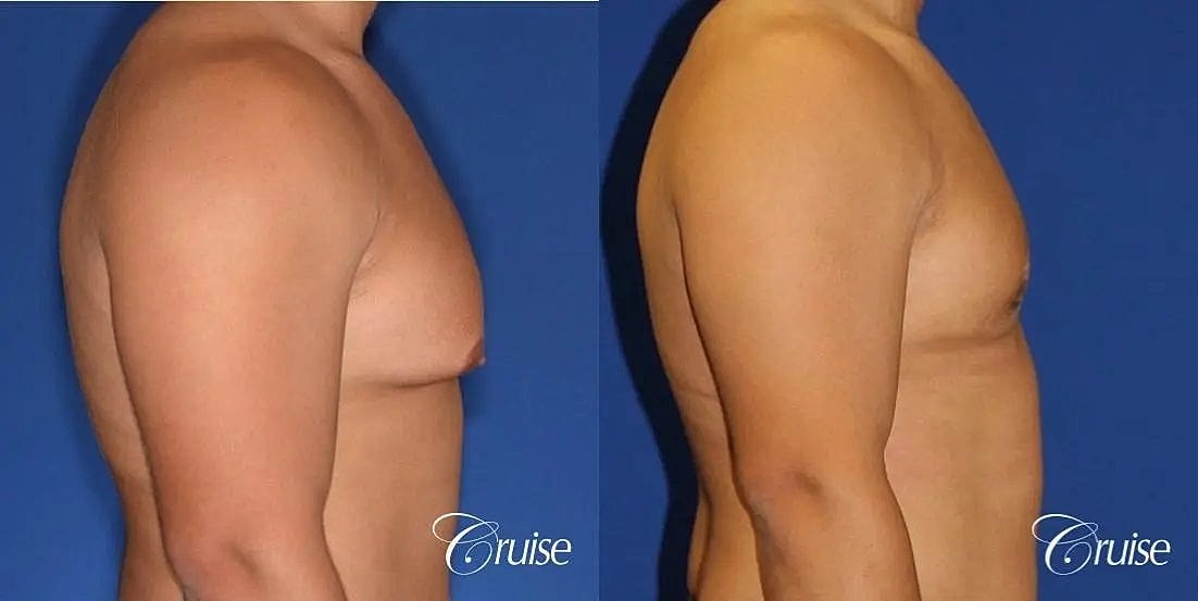 Gynecomastia Surgery Before & After