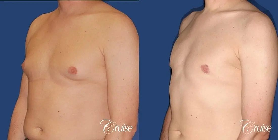 Gynecomastia Surgery Before & After