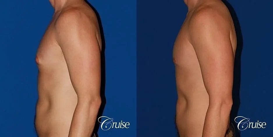 Gynecomastia Surgery Before & After