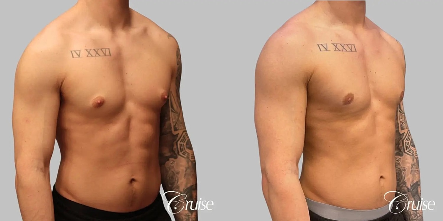 Gynecomastia Surgery Before & After