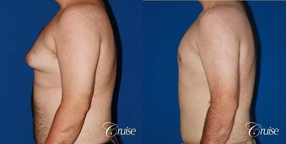 Gynecomastia Surgery Before & After