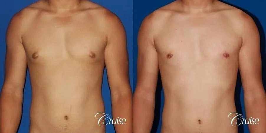 Gynecomastia Surgery Before & After