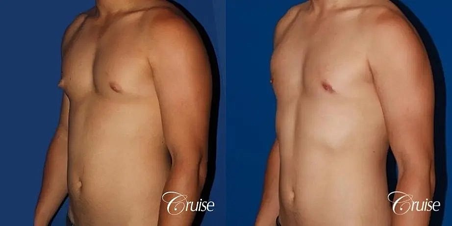 Gynecomastia Surgery Before & After