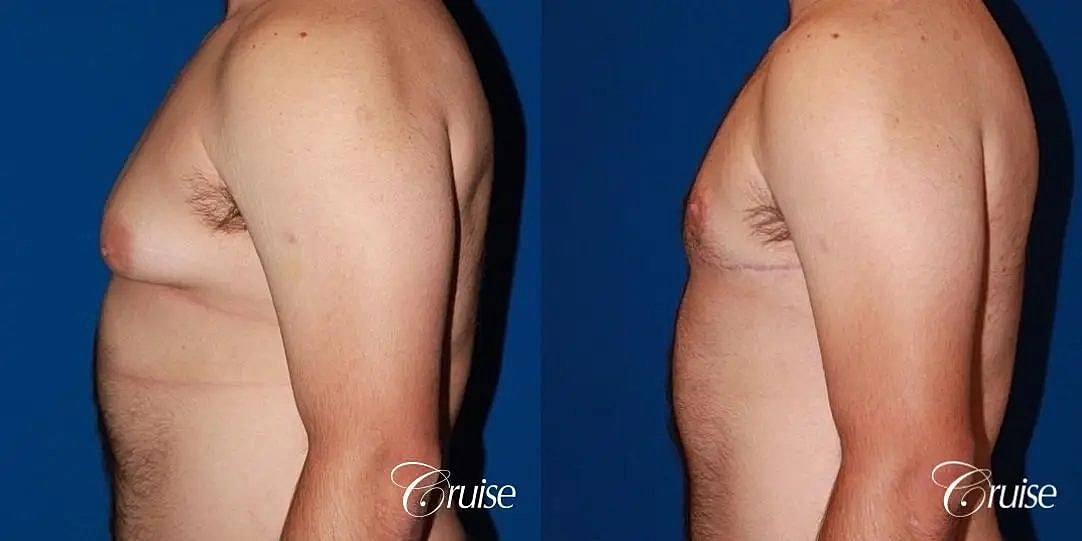Gynecomastia Surgery Before & After