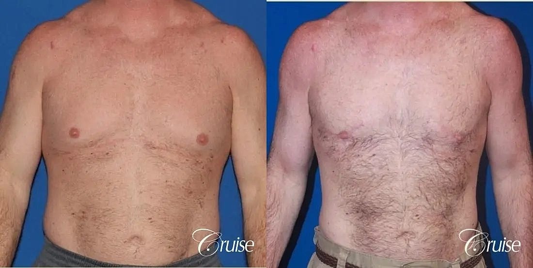 Gynecomastia Surgery Before & After