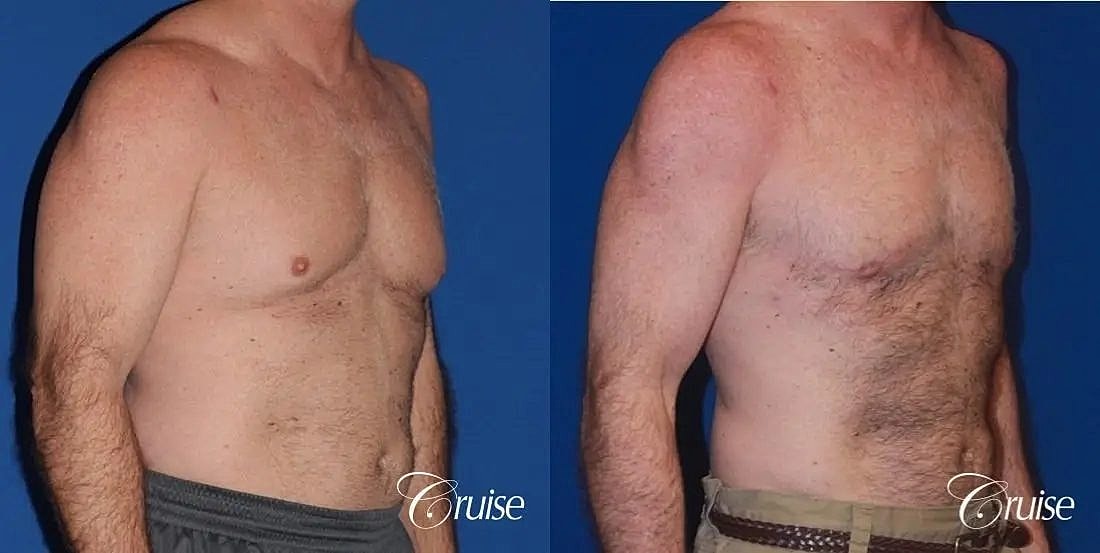 Gynecomastia Surgery Before & After