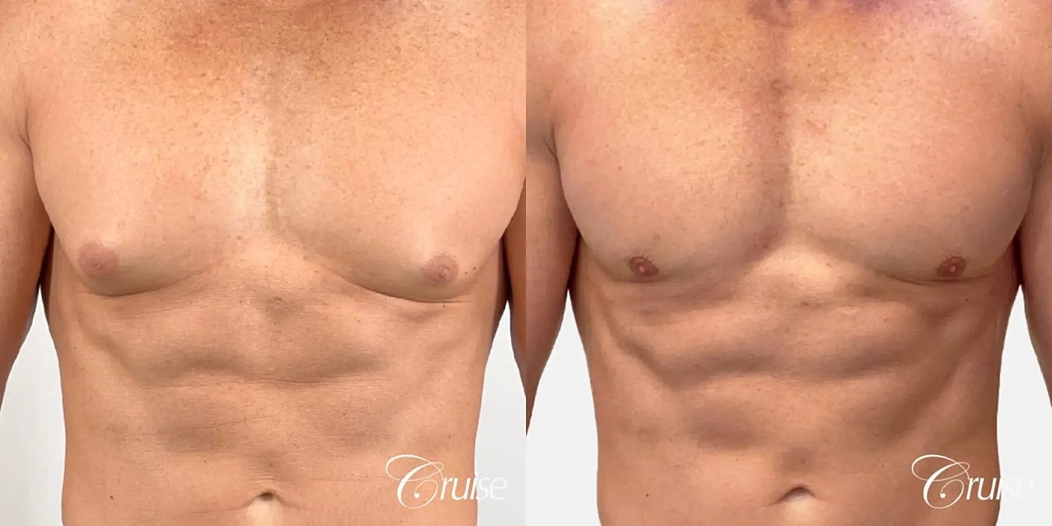 Gynecomastia Surgery Before & After