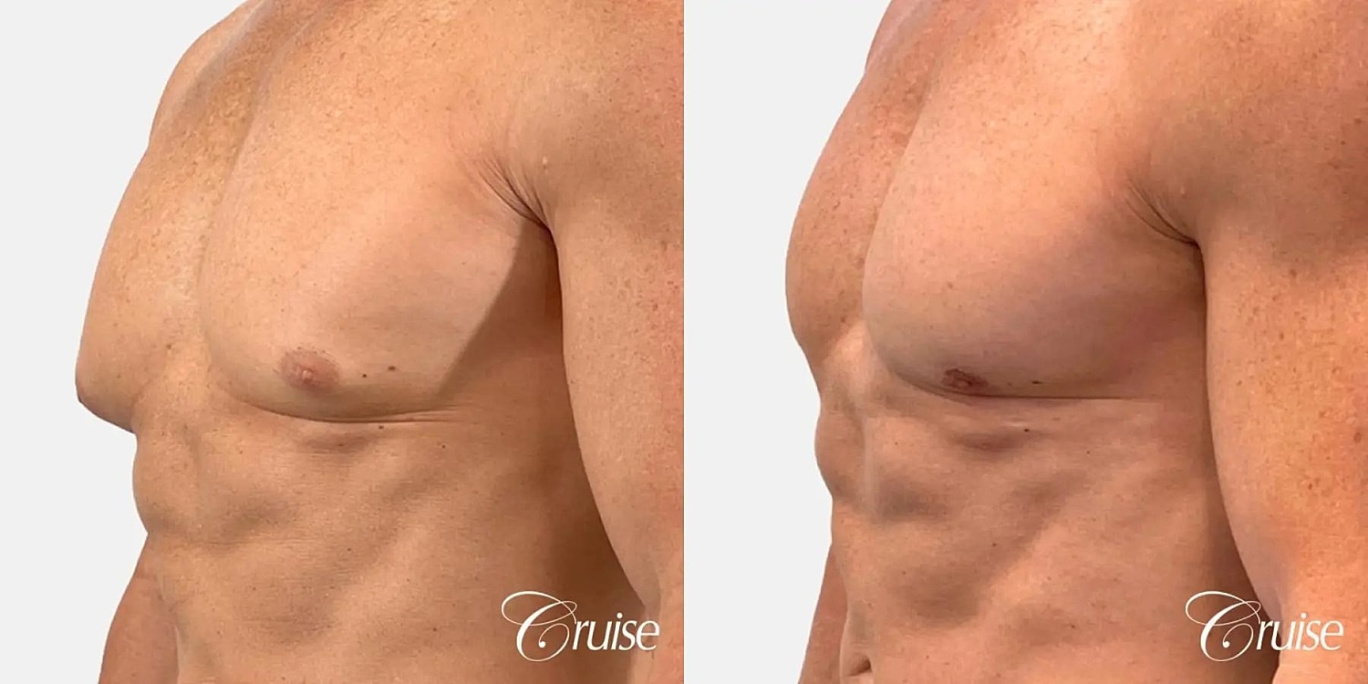 Gynecomastia Surgery Before & After
