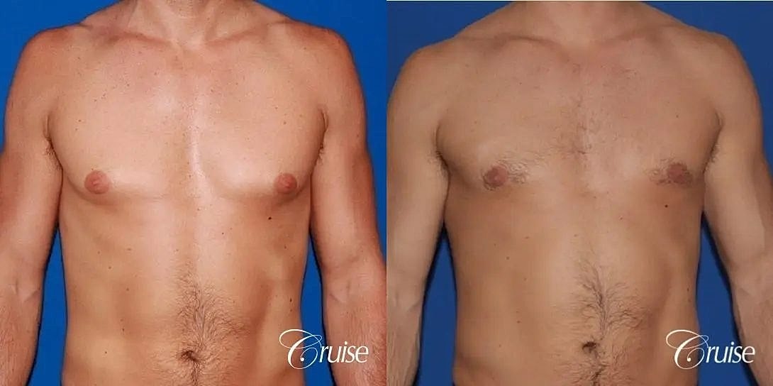 Gynecomastia Surgery Before & After