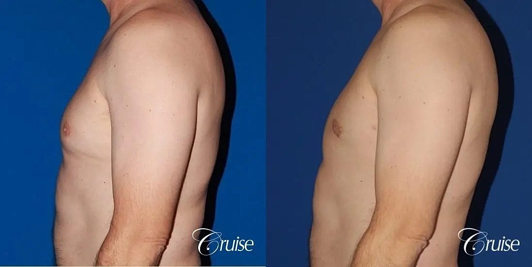 Gynecomastia Surgery Before & After