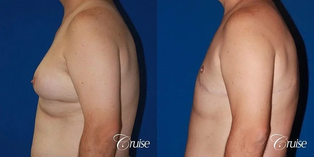 Gynecomastia Surgery Before & After