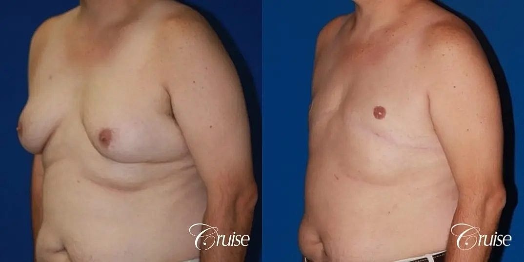 Gynecomastia Surgery Before & After