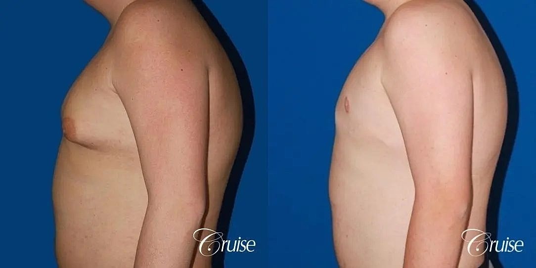 Gynecomastia Surgery Before & After