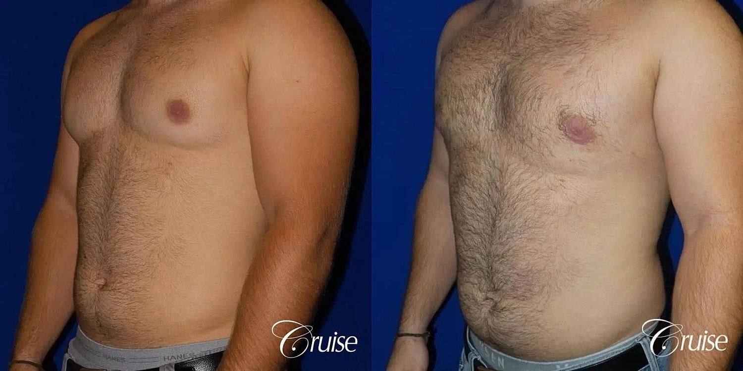 Gynecomastia Surgery Before & After