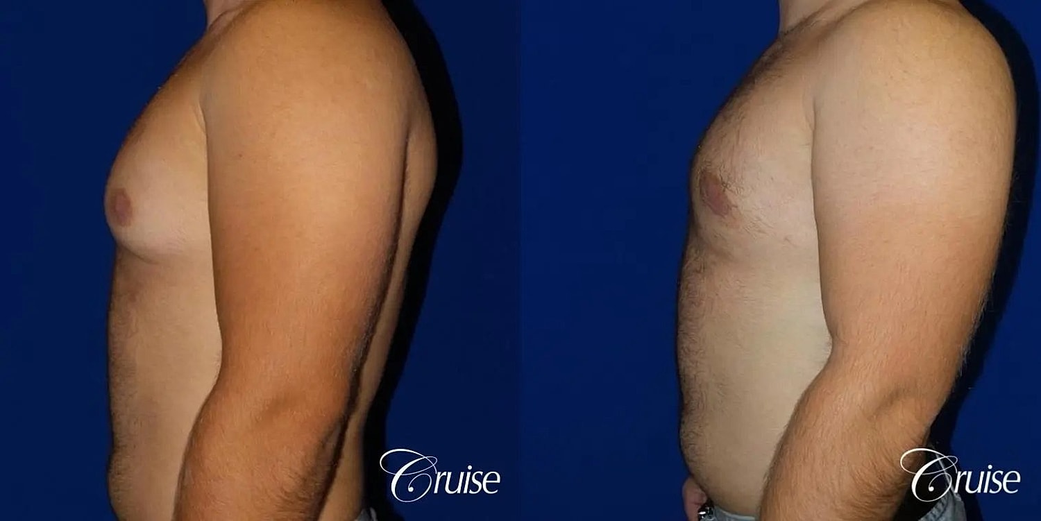 Gynecomastia Surgery Before & After