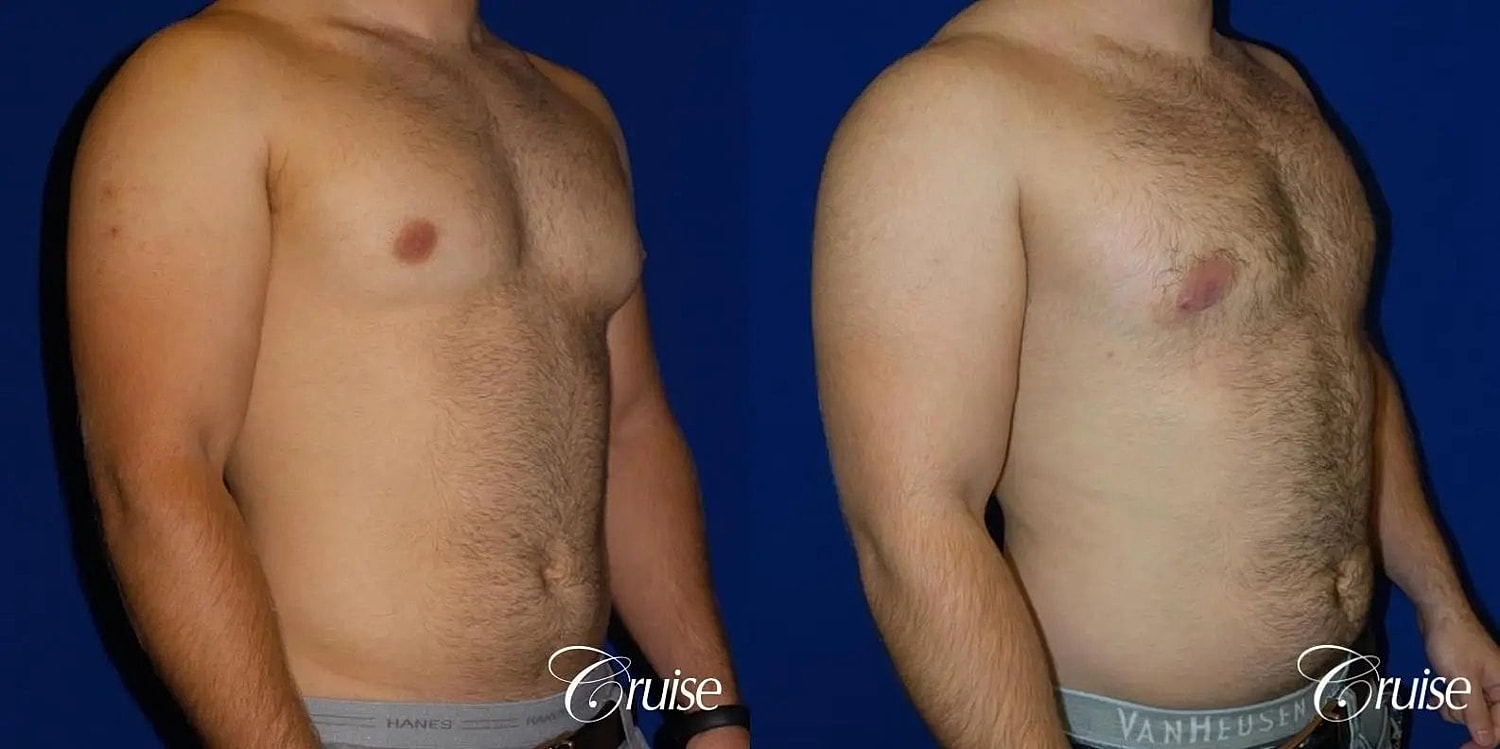Gynecomastia Surgery Before & After
