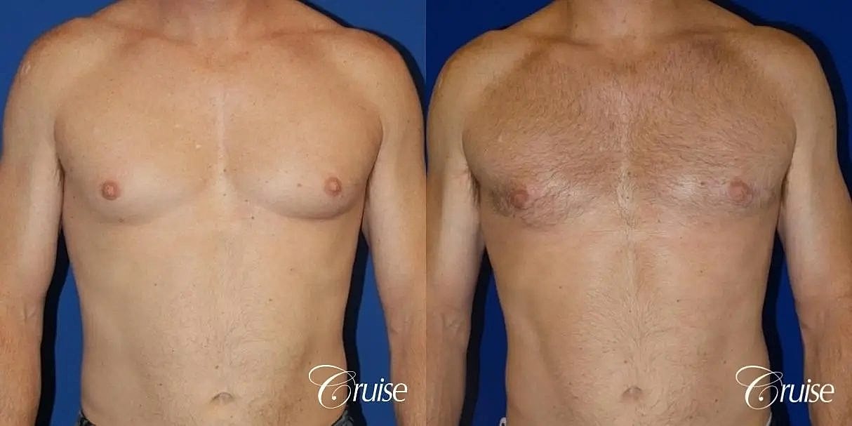 Gynecomastia Surgery Before & After