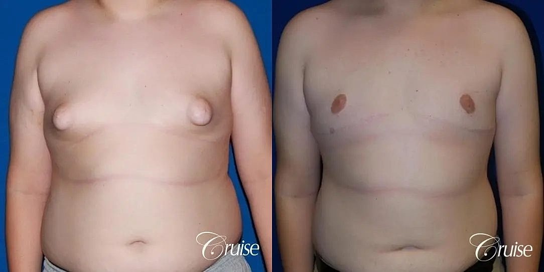 Gynecomastia Surgery Before & After