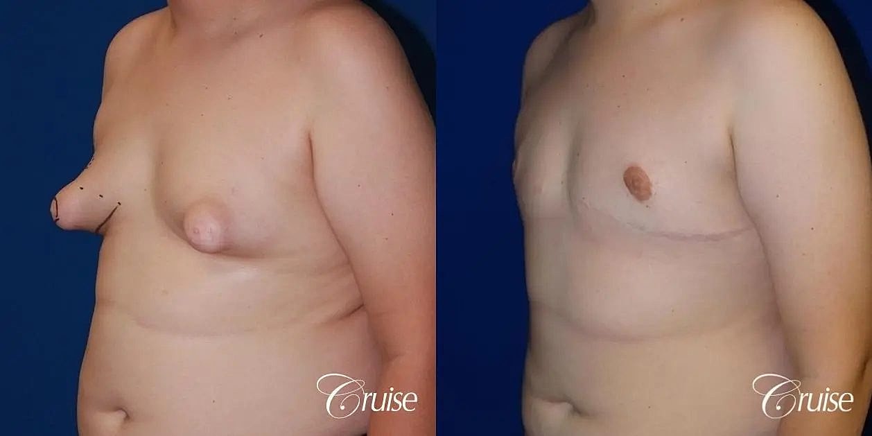 Gynecomastia Surgery Before & After