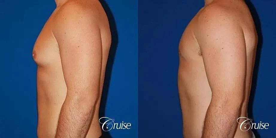 Gynecomastia Surgery Before & After