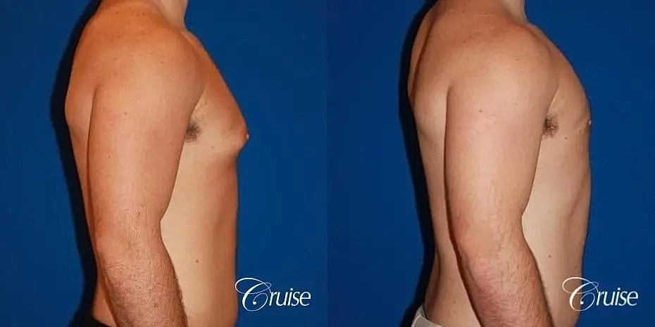 Gynecomastia Surgery Before & After