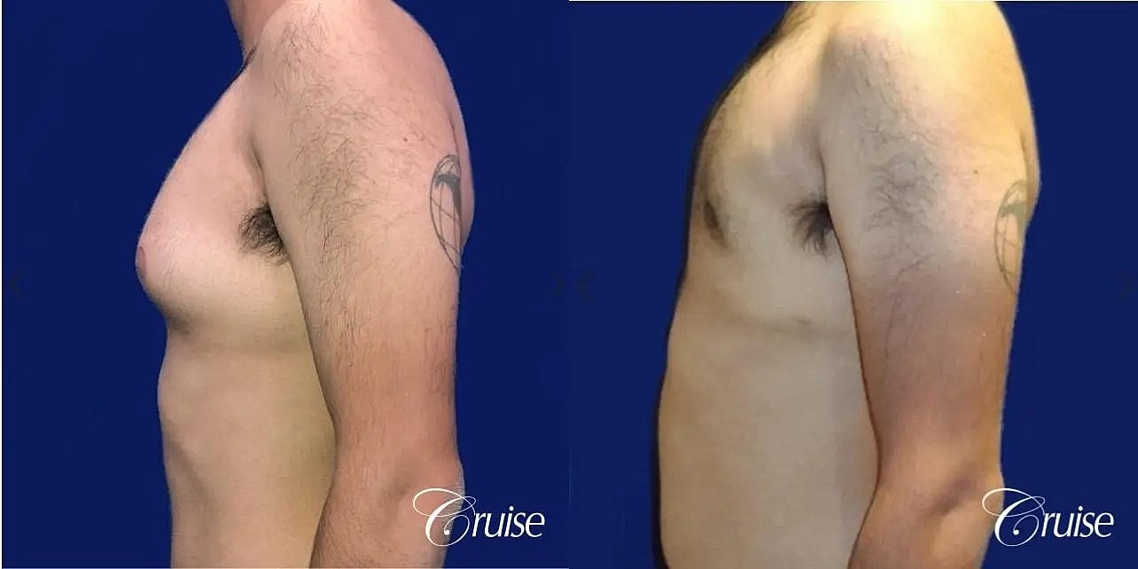 Gynecomastia Surgery Before & After